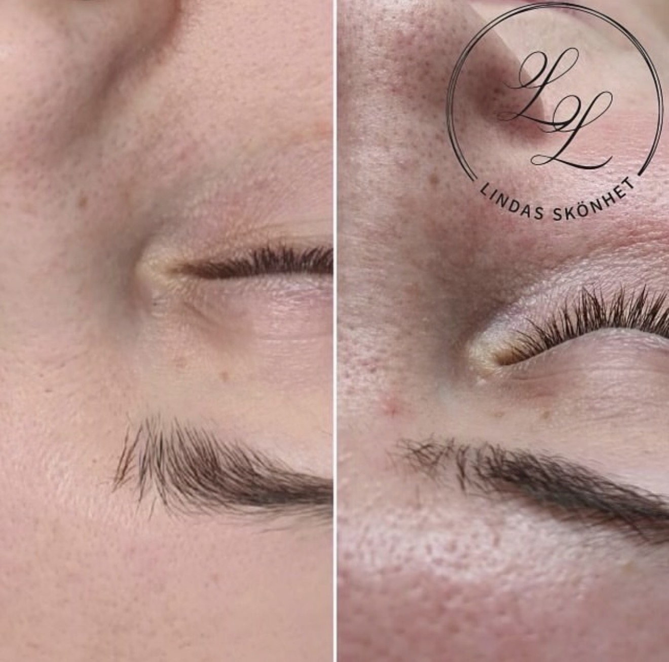 Jämförelsebilder av hudens struktur kring ögat efter microneedling