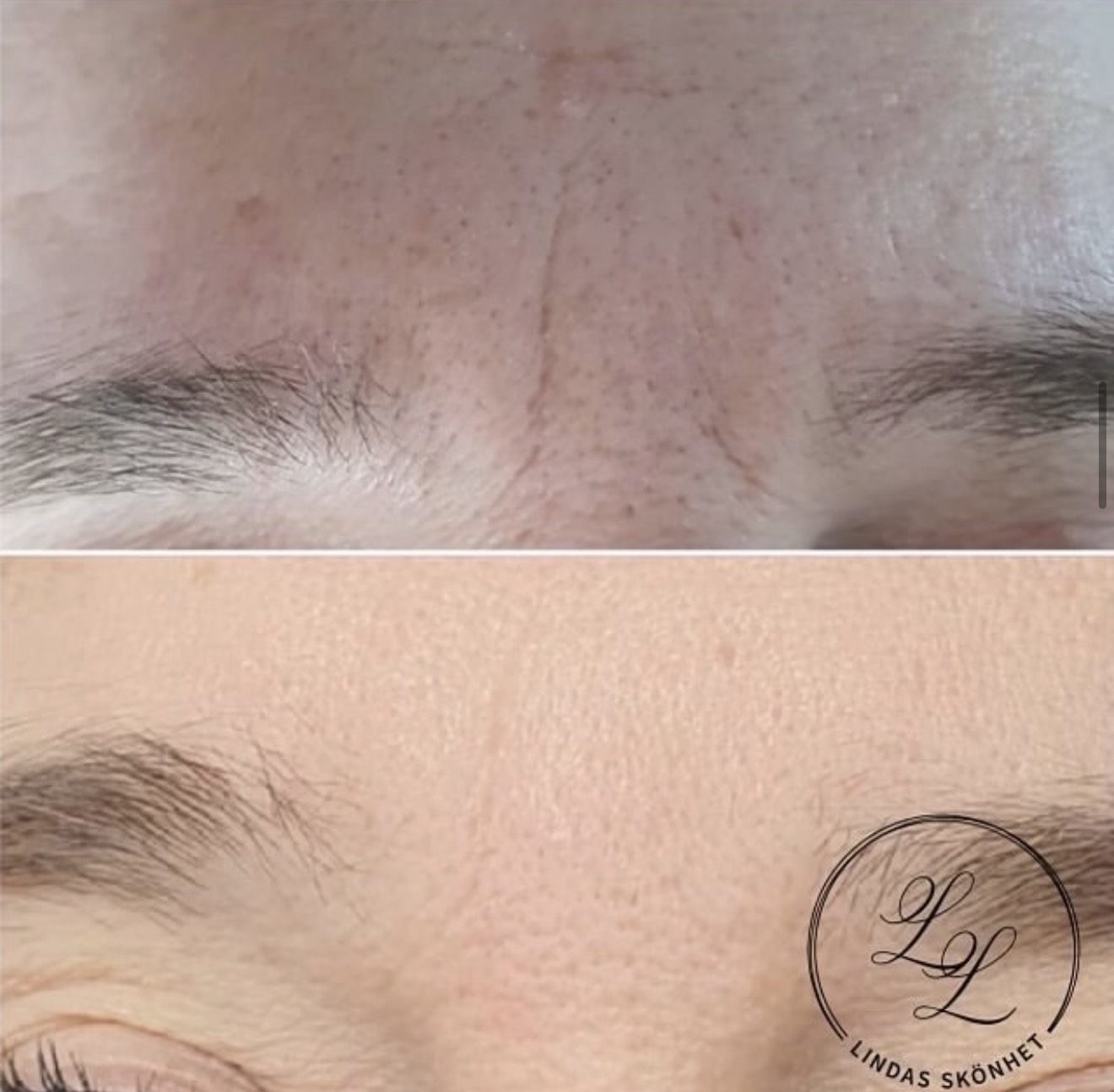 Jämförelsebilder av hudens struktur i pannan efter microneedling