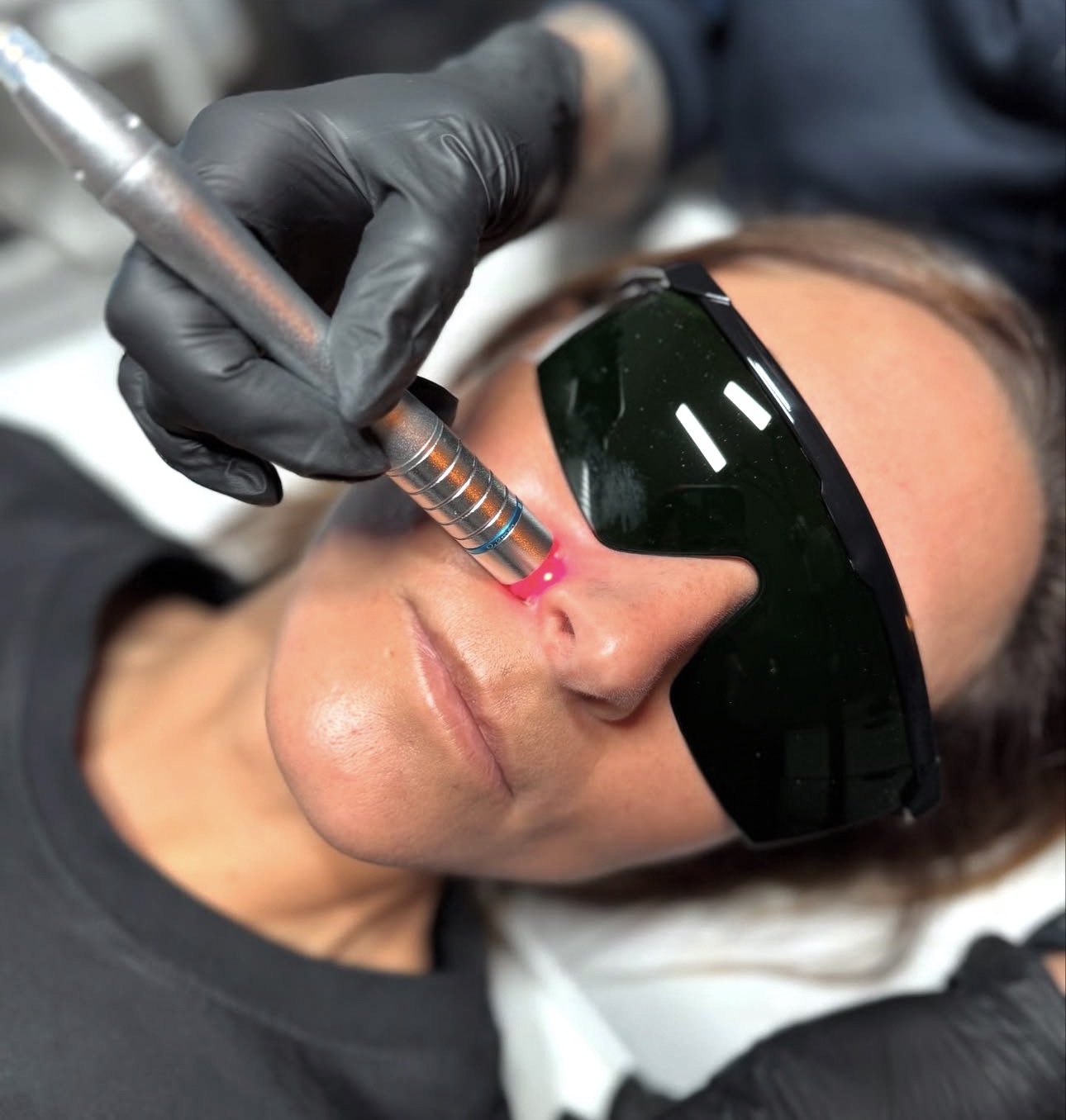 Diodlaser 980 nm-behandling i ansiktet